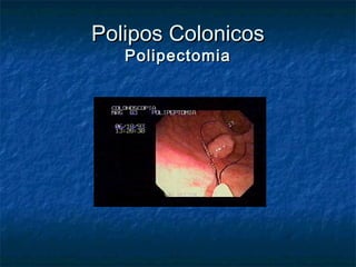 Polipos Colonicos
   Polipectomia
 