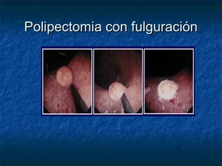 Polipectomia con fulguración
 