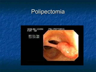 Polipectomia
 