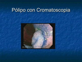 Pólipo con Cromatoscopia
 