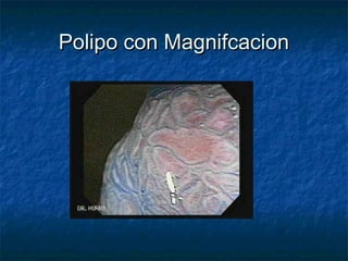 Polipo con Magnifcacion
 