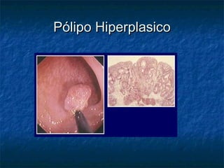 Pólipo Hiperplasico
 