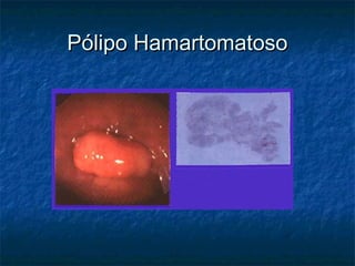 Pólipo Hamartomatoso
 