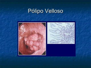 Pólipo Velloso
 