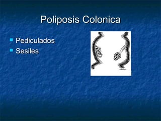 Poliposis Colonica
   Pediculados
   Sesiles
 