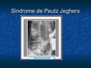Sindrome de Peutz Jeghers
 