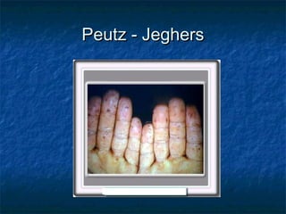 Peutz - Jeghers
 
