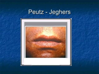 Peutz - Jeghers
 
