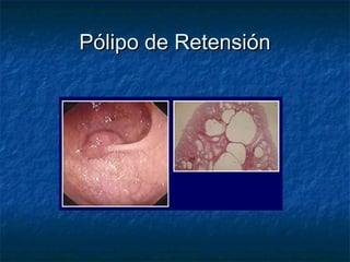 Pólipo de Retensión
 