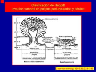 Clasificación de Haggitt invasion tumoral en polipos pedunculados y sésiles Gastroenterology  1985;89:328–336   