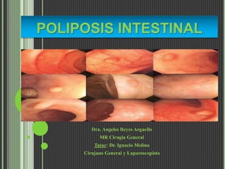 POLIPOSIS INTESTINAL
Dra. Angeles Reyes Arguello
MR Cirugia General
Tutor: Dr. Ignacio Molina
Cirujano General y Laparoscopista
 