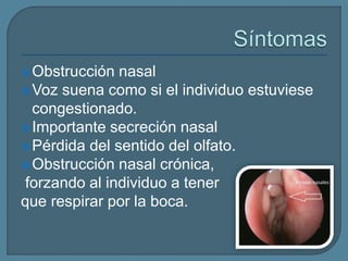 Obstrucción nasal
Voz suena como si el individuo estuviese
congestionado.
Importante secreción nasal
Pérdida del sentido del olfato.
Obstrucción nasal crónica,
forzando al individuo a tener
que respirar por la boca.
 