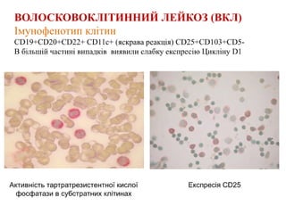 Імунофенотипові маркери клітин кісткового мозку та периферичної крові хворих на В-клітинні неходжкінські лімфоми у фазі лейкемізації