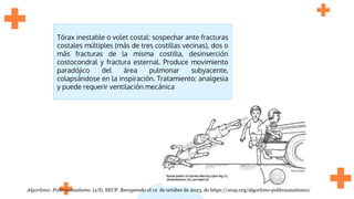 Tórax inestable o volet costal: sospechar ante fracturas
costales múltiples (más de tres costillas vecinas), dos o
más fracturas de la misma costilla, desinserción
costocondral y fractura esternal. Produce movimiento
paradójico del área pulmonar subyacente,
colapsándose en la inspiración. Tratamiento: analgesia
y puede requerir ventilación mecánica
Algoritmo: Politraumatismo. (s/f). SEUP. Recuperado el 12 de octubre de 2023, de https://seup.org/algoritmo-politraumatismo/
 
