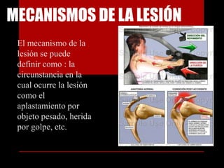 Mecanismos de la lesiónEl mecanismo de la lesión se puede definir como : la circunstancia en la cual ocurre la lesión como el aplastamiento por objeto pesado, herida por golpe, etc.