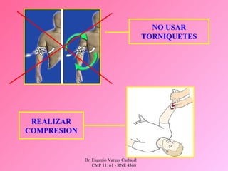 Dr. Eugenio Vargas Carbajal
CMP 11161 - RNE 4368
NO USAR
TORNIQUETES
REALIZAR
COMPRESION
 