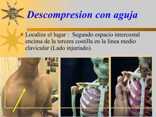 Descompresion con aguja Localize el lugar :  Segundo espacio intercostal encima de la tercera costilla en la linea medio clavicular (Lado injuriado). 