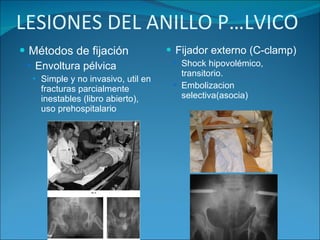 LESIONES DEL ANILLO PÉLVICO Métodos de fijación Envoltura pélvica  Simple y no invasivo, util en fracturas parcialmente inestables (libro abierto), uso prehospitalario Fijador externo (C-clamp) Shock hipovolémico, transitorio. Embolizacion selectiva(asocia)  