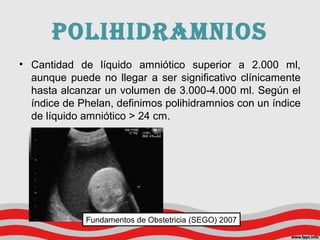 • Cantidad de líquido amniótico superior a 2.000 ml,
aunque puede no llegar a ser significativo clínicamente
hasta alcanzar un volumen de 3.000-4.000 ml. Según el
índice de Phelan, definimos polihidramnios con un índice
de líquido amniótico > 24 cm.
poLIhIdrAmNIoS
Fundamentos de Obstetricia (SEGO) 2007
 