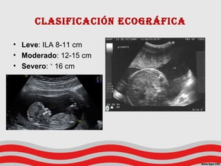 ClasifiCaCión ECográfiCa
• Leve: ILA 8-11 cm
• Moderado: 12-15 cm
• Severo: 16 cm˃
 