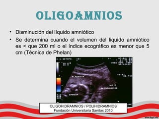 oligoamnios
• Disminución del líquido amniótico
• Se determina cuando el volumen del liquido amniótico
es < que 200 ml o el índice ecográfico es menor que 5
cm (Técnica de Phelan)
OLIGOHIDRAMNIOS / POLIHIDRAMNIOS
Fundación Universitaria Sanitas 2010
 