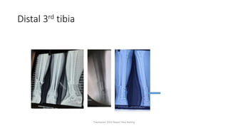 Distal 3rd tibia
Traumacon 2022 Nepal Tibia Nailing
 