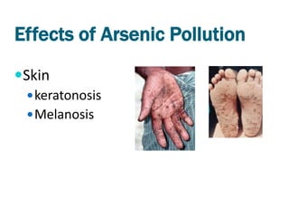 Effects of Arsenic Pollution
Skin
  keratonosis
  Melanosis
 