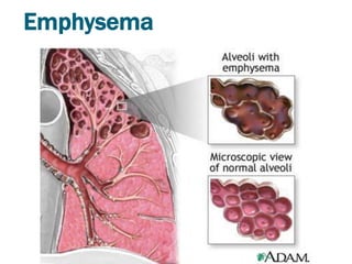 Emphysema
 