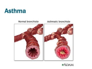 Asthma
 