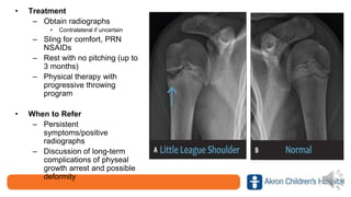 • Treatment
– Obtain radiographs
• Contralateral if uncertain
– Sling for comfort, PRN
NSAIDs
– Rest with no pitching (up to
3 months)
– Physical therapy with
progressive throwing
program
• When to Refer
– Persistent
symptoms/positive
radiographs
– Discussion of long-term
complications of physeal
growth arrest and possible
deformity
 