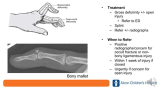 • Treatment
– Gross deformity +/- open
injury
• Refer to ED
– Splint
– Refer +/- radiographs
• When to Refer
– Positive
radiographs/concern for
occult fracture or non-
bony ligamentous injury
– Within 1 week of injury if
closed
– Urgently if concern for
open injury
Bony mallet
 