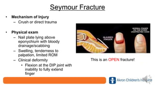 Seymour Fracture
• Mechanism of Injury
– Crush or direct trauma
• Physical exam
– Nail plate lying above
eponychium with bloody
drainage/scabbing
– Swelling, tenderness to
palpation, limited ROM
– Clinical deformity
• Flexion at the DIP joint with
inability to fully extend
finger
This is an OPEN fracture!
 