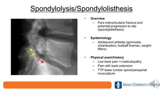 Spondylolysis/Spondylolisthesis
• Overview
– Pars interarticularis fracture and
potential progression to slip
(spondylolisthesis)
• Epidemiology
– Adolescent athletes (gymnasts,
cheerleaders, football linemen, weight-
lifters)
• Physical exam/history
– Low back pain +/-radiculopathy
– Pain with back extension
– TTP lower lumbar spine/paraspinal
musculature
 