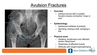 Avulsion Fractures
• Overview
– Indirect trauma with a sudden
forceful muscle contraction “snap or
pop”
• Epidemiology
– Adolescent athletes at puberty
– Sprinting, kicking a ball, swinging a
bat
• Physical exam
– Swelling, tenderness over affected
tendon attachment
– Weakness of affected muscle
– Difficulty with weight bearing/limping
 