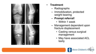 • Treatment
– Radiographs
– Immobilization, protected
weight bearing
– Prompt referral!
• Within 1 week
– Management dependent upon
fracture displacement
• Casting versus surgical
management
• May have associated ACL
laxity
 
