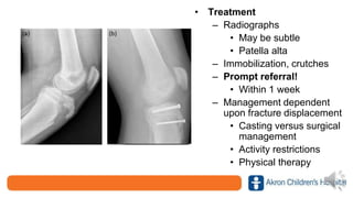 • Treatment
– Radiographs
• May be subtle
• Patella alta
– Immobilization, crutches
– Prompt referral!
• Within 1 week
– Management dependent
upon fracture displacement
• Casting versus surgical
management
• Activity restrictions
• Physical therapy
 