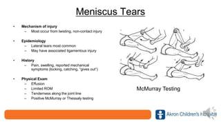Meniscus Tears
• Mechanism of injury
– Most occur from twisting, non-contact injury
• Epidemiology
– Lateral tears most common
– May have associated ligamentous injury
• History
– Pain, swelling, reported mechanical
symptoms (locking, catching, “gives out”)
• Physical Exam
– Effusion
– Limited ROM
– Tenderness along the joint line
– Positive McMurray or Thessaly testing
McMurray Testing
 