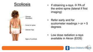 Scoliosis • If obtaining x-rays  PA of
the entire spine (lateral if first
imaging)
• Refer early and for
scoliometer readings > or = 5
degrees
• Low dose radiation x-rays
available in Akron (EOS)
 