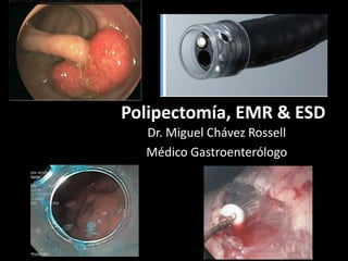 Polipectomía, EMR & ESD
Dr. Miguel Chávez Rossell
Médico Gastroenterólogo
 
