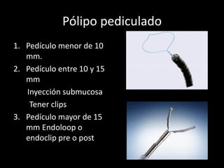 Pólipo pediculado
1. Pedículo menor de 10
mm.
2. Pedículo entre 10 y 15
mm
Inyección submucosa
Tener clips
3. Pedículo mayor de 15
mm Endoloop o
endoclip pre o post
 