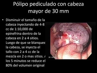 Pólipo pediculado con cabeza
mayor de 30 mm
• Disminuir el tamaño de la
cabeza inyectando de 4-8
cc de 1:10,000 de
epinefrina dentro de la
cabeza en 2 a 4 sitios.
Luego de que se blanquee
la cabeza, se inyecta el
tallo con 2 a 4 cc de la
mezcla en 2 o mas sitios. A
los 5 minutos se reduce el
80% del volumen original
 