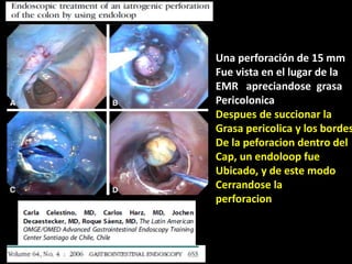 Una perforación de 15 mm
Fue vista en el lugar de la
EMR apreciandose grasa
Pericolonica
Despues de succionar la
Grasa pericolica y los bordes
De la peforacion dentro del
Cap, un endoloop fue
Ubicado, y de este modo
Cerrandose la
perforacion
 