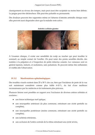 - Support de Cours (Version PDF) -
- © Université Médicale Virtuelle Francophone -
classiquement au niveau des tempes, mais peut aussi être occipitale ou moins bien définie.
Le peigne peut être déclencheur. Elle peut être pulsatile ou permanente.
Des douleurs peuvent être rapportées même en l'absence d'atteinte artérielle clinique mais
elles peuvent aussi disparaître alors que la maladie reste active.
Artérité à cellules géantes
À l'examen clinique, il existe une sensibilité du scalp au toucher qui peut troubler le
sommeil, au simple contact de l'oreiller. On peut noter des points sensibles électifs, des
nodules à la palpation et à l'inspection de petits infarctus cutanés. Les vaisseaux sont en
général épaissis, indurés, et nodulaires, sans pulsations. Ils peuvent même être enflammés
et visibles dès l'observation.
IV.3.2 Manifestations ophtalmologiques
Des troubles visuels existent dans 25 à 50 % des cas, bien que l'incidence de perte de la vue
soit maintenant considérée comme plus faible 6-10 %, du fait d'une meilleure
reconnaissance par les médecins et de traitements plus précoces.
Plusieurs lésions sont possibles en rapport avec l'occlusion de diverses artères orbitales et
oculaires :
une lésion ischémique nerf optique,
une neuropathie antérieure (la plus commune, entraînant une cécité partielle ou
complète),
une neuropathie postérieure (moins commune, entraînant une cécité partielle ou
complète),
une ischémie rétinienne,
une occlusion de l'artère centrale de la rétine entraînant une cécité sévère,
 