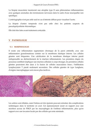 - Support de Cours (Version PDF) -
- © Université Médicale Virtuelle Francophone -
La biopsie musculaire montrerait une atrophie type II sans phénomènes inflammatoires
avec quelques anomalies des terminaisons nerveuses dans le cadre d'une neuropathie non
spécifique.
L'artériographie n'est pas utile sauf en cas d'atteinte diffuse pour visualiser l'aorte.
La biopsie d'artère temporale n'est pas utile chez les patients suspects de
pseudopolyarthrite rhizomélique.
Elle doit être faite avant traitement corticoïde.
V PATHOLOGIE
V.1 MORPHOLOGIE
Il existe une inflammation segmentaire chronique de la paroi artérielle, avec une
inflammation granulomateuse centrée sur la membrane élastique interne. Les cellules
géantes sont fréquentes. Une calcification de la membrane élastique interne paraît
indispensable au déclenchement de la réaction inflammatoire. Les premières étapes du
processus semblent impliquer une réaction cellulaire à corps étranger, les premières cellules
géantes pourraient être dues à la fusion de cellules musculaires lisses ; l'infiltration
lymphocytaire T paraît seulement secondaire. Des cellules géantes de type Langhans,
d'origine macrophagique sont encore plus tardives.
Les artères sont dilatées, mais l'intima est très épaissie pouvant entraîner des complications
ischémiques dans le territoire en aval. Cet épaississement serait en rapport avec une
sécrétion accrue de PDGF par les macrophages de l'infiltrat inflammatoire, plus qu'en
rapport avec une invasion locale par des cellules qui reste minimale.
 