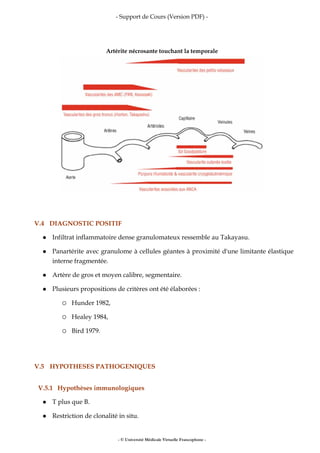 - Support de Cours (Version PDF) -
- © Université Médicale Virtuelle Francophone -
Artérite nécrosante touchant la temporale
V.4 DIAGNOSTIC POSITIF
Infiltrat inflammatoire dense granulomateux ressemble au Takayasu.
Panartérite avec granulome à cellules géantes à proximité d'une limitante élastique
interne fragmentée.
Artère de gros et moyen calibre, segmentaire.
Plusieurs propositions de critères ont été élaborées :
Hunder 1982,
Healey 1984,
Bird 1979.
V.5 HYPOTHESES PATHOGENIQUES
V.5.1 Hypothèses immunologiques
T plus que B.
Restriction de clonalité in situ.
 