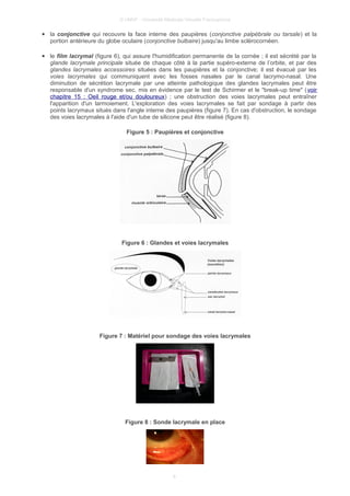 © UMVF - Université Médicale Virtuelle Francophone
● la conjonctive qui recouvre la face interne des paupières (conjonctive palpébrale ou tarsale) et la
portion antérieure du globe oculaire (conjonctive bulbaire) jusqu'au limbe sclérocornéen.
● le film lacrymal (figure 6), qui assure l'humidification permanente de la cornée ; il est sécrété par la
glande lacrymale principale située de chaque côté à la partie supéro-externe de l’orbite, et par des
glandes lacrymales accessoires situées dans les paupières et la conjonctive; il est évacué par les
voies lacrymales qui communiquent avec les fosses nasales par le canal lacrymo-nasal. Une
diminution de sécrétion lacrymale par une atteinte pathologique des glandes lacrymales peut être
responsable d'un syndrome sec, mis en évidence par le test de Schirmer et le "break-up time" (voir
chapitre 15 : Oeil rouge et/ou douloureux) ; une obstruction des voies lacrymales peut entraîner
l'apparition d'un larmoiement. L'exploration des voies lacrymales se fait par sondage à partir des
points lacrymaux situés dans l'angle interne des paupières (figure 7). En cas d'obstruction, le sondage
des voies lacrymales à l'aide d'un tube de silicone peut être réalisé (figure 8).
Figure 5 : Paupières et conjonctive
Figure 6 : Glandes et voies lacrymales
Figure 7 : Matériel pour sondage des voies lacrymales
Figure 8 : Sonde lacrymale en place
8
 
