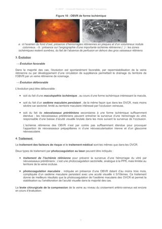 © UMVF - Université Médicale Virtuelle Francophone
Figure 10 : OBVR de forme ischémique
a : à l’examen du fond d’oeil, présence d’hémorragies rétiniennes en plaques et d’un volumineux nodule
cotonneux. - b : présence sur l’angiographie d’une importante ischémie rétinienne () : les zones
ischémiques restent sombres, du fait de l’absence de perfusion en dehors des gros vaisseaux rétiniens.
3. Évolution
→ Évolution favorable
Dans la majorité des cas, l’évolution est spontanément favorable, par reperméabilisation de la veine
rétinienne ou par développement d’une circulation de suppléance permettant le drainage du territoire de
l’OBVR par un veine rétinienne de voisinage.
→ Évolution défavorable
L'évolution peut être défavorable :
● soit du fait d’une maculopathie ischémique , au cours d’une forme ischémique intéressant la macula,
● soit du fait d’un oedème maculaire persistant , de la même façon que dans les OVCR, mais moins
sévère car sectoriel, limité au territoire maculaire intéressé par l’occlusion veineuse,
● soit du fait de néovaisseaux prérétiniens secondaires à une forme ischémique suffisamment
étendue ; les néovaisseaux prérétiniens peuvent entraîner la survenue d’une hémorragie du vitré,
responsable d’une baisse d’acuité visuelle brutale dans les mois suivant la survenue de l’occlusion.
L’ischémie rétinienne des OBVR n’est par contre pas suffisamment étendue pour provoquer
l’apparition de néovaisseaux prépapillaires ni d’une néovascularisation irienne et d’un glaucome
néovasculaire.
4. Traitement
Le traitement des facteurs de risque et le traitement médical sont les mêmes que dans les OVCR.
Deux types de traitement par photocoagulation au laser peuvent être indiqués :
● traitement de l’ischémie rétinienne pour prévenir la survenue d’une hémorragie du vitré par
néovaisseaux prérétiniens ; c’est une photocoagulation sectorielle, analogue à la PPR, mais limitée au
territoire de la veine occluse.
● photocoagulation maculaire , indiquée en présence d’une OBVR datant d’au moins trois mois,
compliquée d’un oedème maculaire persistant avec une acuité visuelle ≤ 5/10èmes. Ce traitement
donne de meilleurs résultats que la photocoagulation de l’oedème maculaire des OVCR et permet la
stabilisation ou l’amélioration de l’acuité visuelle dans la majorité des cas.
La levée chirurgicale de la compression de la veine au niveau du croisement artério-veineux est encore
en cours d’évaluation.
9
 