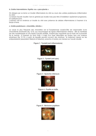 © UMVF - Université Médicale Virtuelle Francophone
b. Uvéite intermédiaire« Hyalite »ou « pars-planite »
On désigne par ce terme un trouble inflammatoire du vitré au cours des uvéites postérieures (inflammation
du vitré)
La baisse d’acuité visuelle n’est en général pas brutale mais peut être d’installation rapidement progressive,
en quelques jours.
L’examen met en évidence un trouble du vitré avec présence de cellules inflammatoires à l’examen à la
lampe à fente.
c. Uvéite postérieure « choroïdite, rétinite »
La cause la plus fréquente des choroïdites est la Toxoplasmose oculaire.Elle est responsable d’une
choriorétinite récidivante (fig. 12.9), qui s’accompagne de signes inflammatoires vitréens : elle se manifeste
par des myodésopsies et une baisse d’acuité variable, d’autant plus importante que le foyer est à proximité
de la macula ; à l’examen du fond d’œil, il s’agit d’un foyer blanchâtre qui évolue vers une cicatrice
atrophique (fig. 12.10), à partir de laquelle peuvent survenir des récidives ; le traitement repose sur les
antiparasitaires (association Malocid et Adiazine), prescrits s’il existe une menace sur l’acuité visuelle
Figure 1 : Tyndall (oeil inflammatoire)
Figure 2 : Tyndall (oeil sain)
Figure 3 : Synéchie inférieure
Figure 4 : Pupille en trèfle
Figure 5 : Séclusion pupillaire
5
 