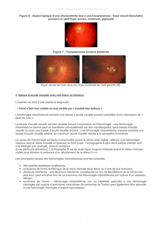 © UMVF - Université Médicale Virtuelle Francophone
Figure 6 : Aspect typique d’une choriorétinite due à une toxoplasmose : foyer récent blanchâtre
jouxtant un petit foyer ancien, cicatriciel, pigmenté
Figure 7 : Toxoplasmose oculaire bilatérale
Foyer récent de l’oeil droit (A), foyer cicatriciel de l’oeil gauche (B).
2. Baisse d’acuité visuelle avec oeil blanc et indolore
L’examen du fond d’oeil oriente le diagnostic :
→ Fond d’oeil non visible ou mal visible par « trouble des milieux »
L'hémorragie intravitréenne entraîne une baisse d’acuité visuelle souvent précédée d’une impression de «
pluie de suie ».
La baisse d’acuité visuelle est très variable suivant l’importance de l’hémorragie : une hémorragie
intravitréenne minime peut se manifester principalement par des myodésopsies, sans baisse d’acuité
visuelle ou avec une baisse d’acuité visuelle minime ; une hémorragie intravitréenne massive entraîne une
baisse d’acuité visuelle sévère, au maximum acuité visuelle réduite à la perception lumineuse.
La cause de l’hémorragie est facile à reconnaître quand la rétine reste visible ; ailleurs, une hémorragie
massive rend la rétine invisible à l’examen du fond d’oeil : l’échographie B peut alors parfois orienter vers
une étiologie (par exemple, mise en évidence
d’une déchirure rétinienne). L’échographie B est de toute façon toujours indiquée quand la rétine n’est pas
visible pour éliminer la présence d’un décollement de la rétine (+++).
Les principales causes des hémorragies intravitréennes sont les suivantes :
● rétinopathie diabétique proliférante,
● occlusions de forme ischémique de la veine centrale de la rétine ou d’une de ses branches,
● déchirure rétinienne : une déchirure rétinienne, compliquée ou non de décollement de la rétine (voir
plus loin), peut entraîner lors de sa survenue une hémorragie intravitréenne par rupture d’un vaisseau
rétinien,
● syndrome de Terson : hémorragie intravitréenne uni- ou bilatérale associée à une hémorragie
méningée par rupture d’anévrisme intracrânien (le syndrome de Terson peut également être associée
à une hémorragie méningée d’origine traumatique).
6
 