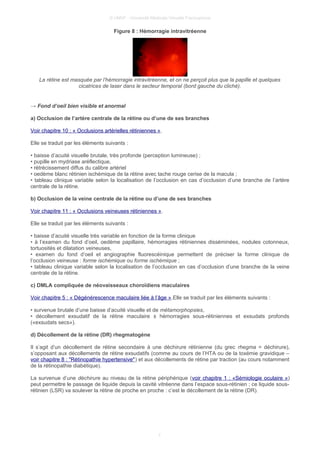 © UMVF - Université Médicale Virtuelle Francophone
Figure 8 : Hémorragie intravitréenne
La rétine est masquée par l’hémorragie intravitréenne, et on ne perçoit plus que la papille et quelques
cicatrices de laser dans le secteur temporal (bord gauche du cliché).
→ Fond d’oeil bien visible et anormal
a) Occlusion de l’artère centrale de la rétine ou d’une de ses branches
Voir chapitre 10 : « Occlusions artérielles rétiniennes ».
Elle se traduit par les éléments suivants :
• baisse d’acuité visuelle brutale, très profonde (perception lumineuse) ;
• pupille en mydriase aréflectique,
• rétrécissement diffus du calibre artériel
• oedème blanc rétinien ischémique de la rétine avec tache rouge cerise de la macula ;
• tableau clinique variable selon la localisation de l’occlusion en cas d’occlusion d’une branche de l’artère
centrale de la rétine.
b) Occlusion de la veine centrale de la rétine ou d’une de ses branches
Voir chapitre 11 : « Occlusions veineuses rétiniennes ».
Elle se traduit par les éléments suivants :
• baisse d’acuité visuelle très variable en fonction de la forme clinique
• à l’examen du fond d’oeil, oedème papillaire, hémorragies rétiniennes disséminées, nodules cotonneux,
tortuosités et dilatation veineuses,
• examen du fond d’oeil et angiographie fluorescéinique permettent de préciser la forme clinique de
l’occlusion veineuse : forme ischémique ou forme ischémique ;
• tableau clinique variable selon la localisation de l’occlusion en cas d’occlusion d’une branche de la veine
centrale de la rétine.
c) DMLA compliquée de néovaisseaux choroïdiens maculaires
Voir chapitre 5 : « Dégénérescence maculaire liée à l’âge ».Elle se traduit par les éléments suivants :
• survenue brutale d’une baisse d’acuité visuelle et de métamorphopsies,
• décollement exsudatif de la rétine maculaire ± hémorragies sous-rétiniennes et exsudats profonds
(«exsudats secs»).
d) Décollement de la rétine (DR) rhegmatogène
Il s’agit d’un décollement de rétine secondaire à une déchirure rétinienne (du grec rhegma = déchirure),
s’opposant aux décollements de rétine exsudatifs (comme au cours de l’HTA ou de la toxémie gravidique –
voir chapitre 8 : "Rétinopathie hypertensive") et aux décollements de rétine par traction (au cours notamment
de la rétinopathie diabétique).
La survenue d’une déchirure au niveau de la rétine périphérique (voir chapitre 1 : «Sémiologie oculaire »)
peut permettre le passage de liquide depuis la cavité vitréenne dans l’espace sous-rétinien ; ce liquide sous-
rétinien (LSR) va soulever la rétine de proche en proche : c’est le décollement de la rétine (DR).
7
 